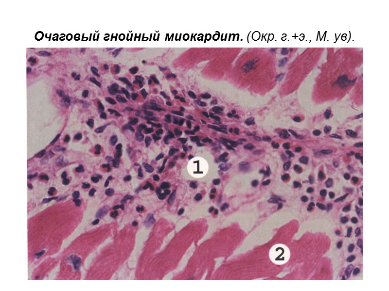 Очаговый гнойный миокардит. (Окр. г.+э., М. ув).